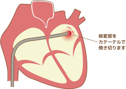 アブレーション治療