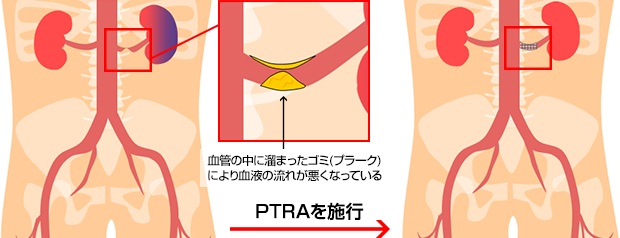 腎動脈形成術治療