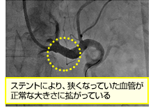 腎動脈形成術治療　治療後