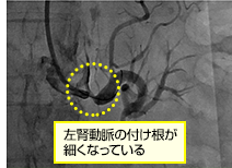 腎動脈形成術治療　治療前