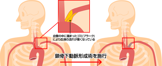 鎖骨下動脈形成術