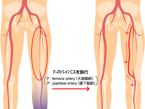 F－Pバイパス