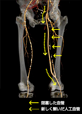 F－Pバイパス　治療後CT検査画像