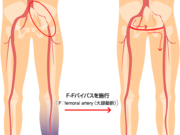 F－Fバイパス