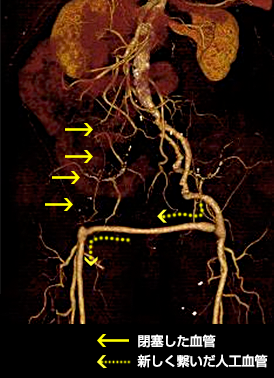 F－Fバイパス　治療後CT検査画像