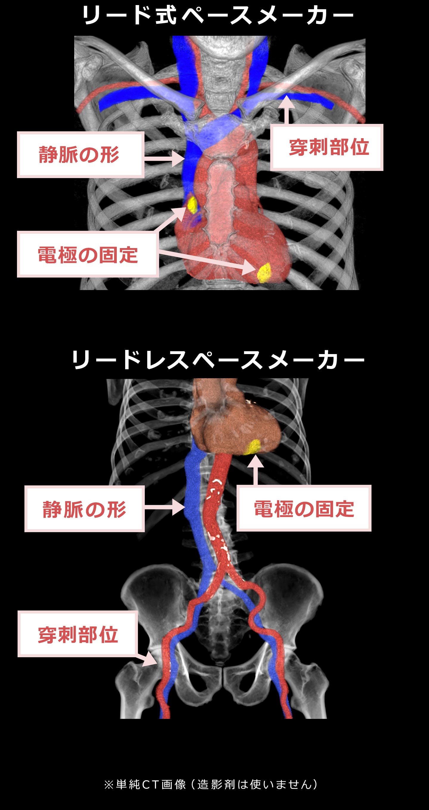 CT画像