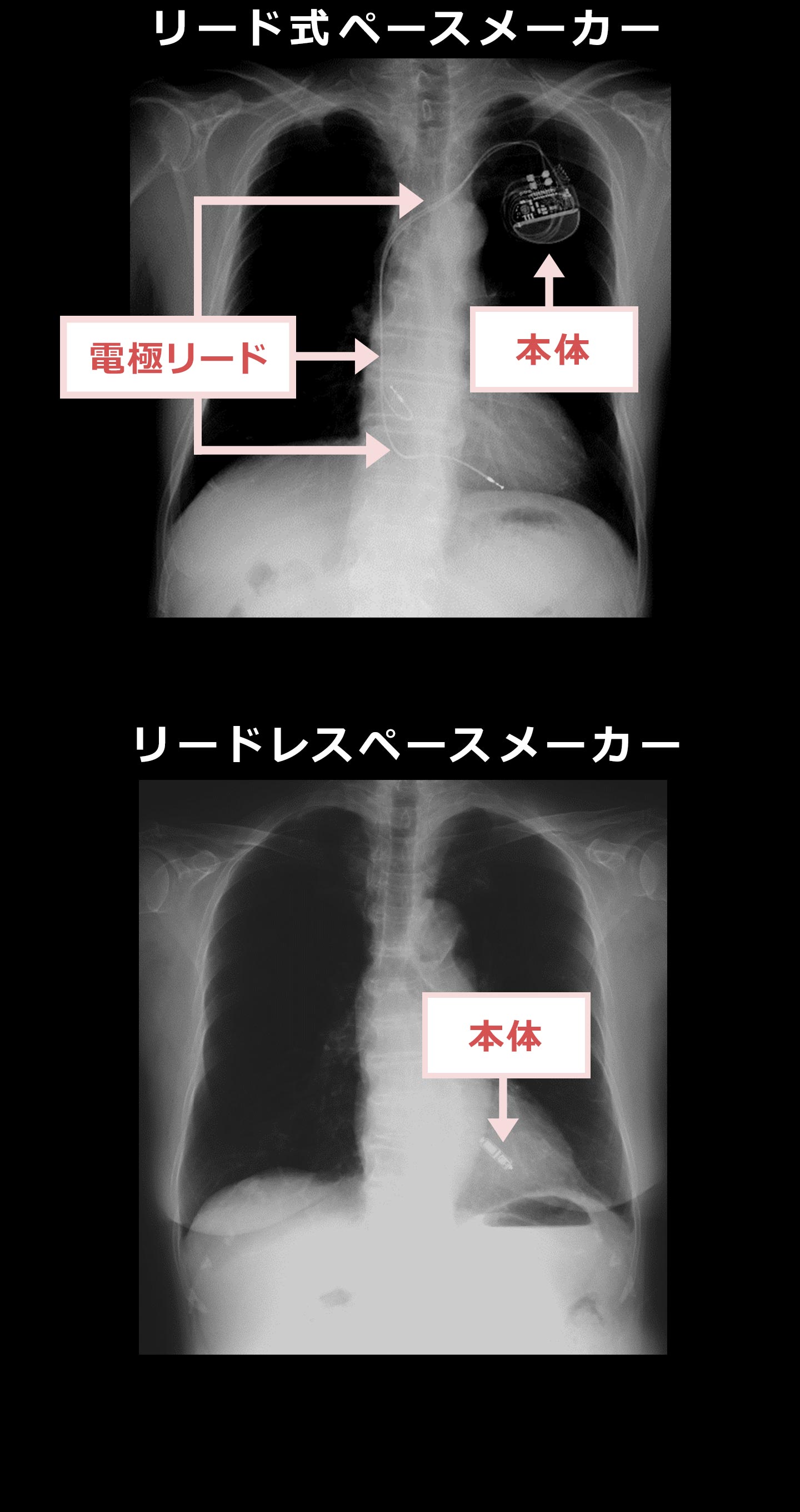 CT画像