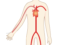 手首から冠動脈の入り口まで