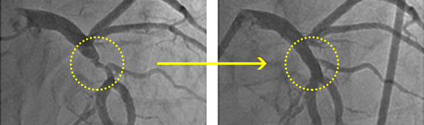 PCI前・後のカテーテル画像