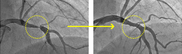 PCI前・後のカテーテル画像