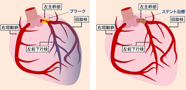 LMT病変の治療イメージ治療前・治療後