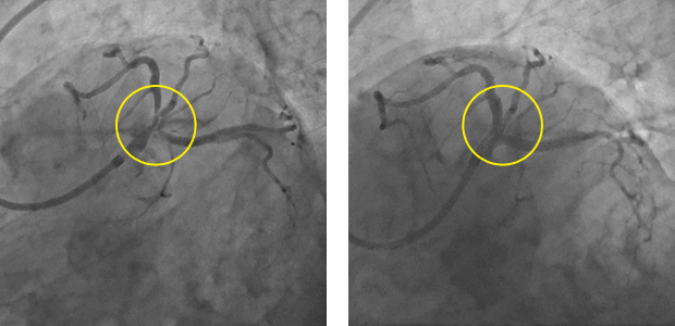 PCI前・後のカテーテル画像
