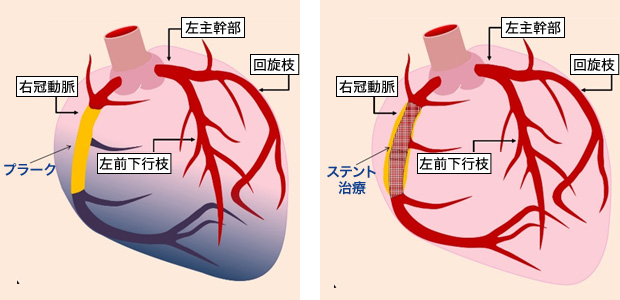 CTO病変の治療イメージ