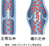 正常な弁と病変がある弁